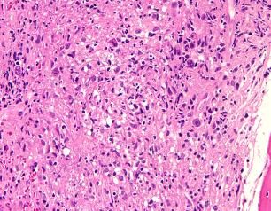 Histological section from a tissue affected by Autoimmune Lymphoproliferative Syndrome