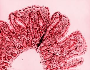 Light micrograph of small bowel tissue affected by cholera