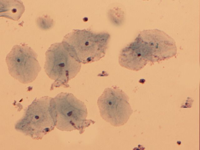 Clue cells, which are a key diagnostic indicator for bacterial vaginosis