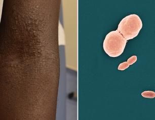 Malassezia yeasts, commensal fungi that are associated with a number of skin disorders including eczema