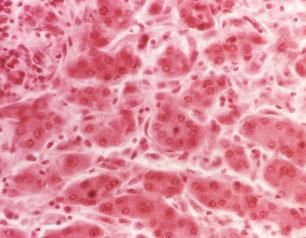 Micrograph of liver tissue showing signs of hepatitis