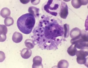 Bone marrow smear with a macrophage containing numerous Leishmania amastigotes