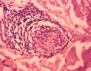 Micrograph showing a granuloma, a type of inflammatory reaction characteristic of leprosy