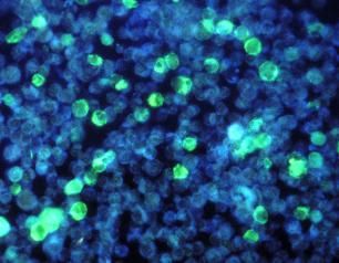 Cells infected with Primary Immune Deficiency Diseases (PIDDs) visualized using immunofluorescence