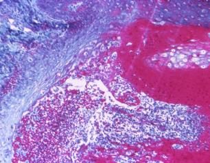 Histopathology slide of smallpox-infected skin tissue
