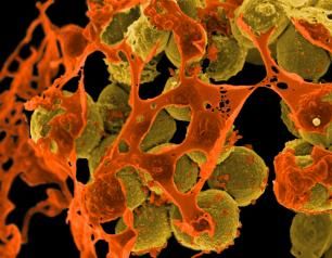 Image of Staphylococcus aureus, a bacterium that causes frequent infections in people with STAT3 dominant-negative disease