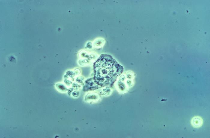 Photomicrograph showing clusters of Trichomonas vaginali, the causative agent of trichomoniasis